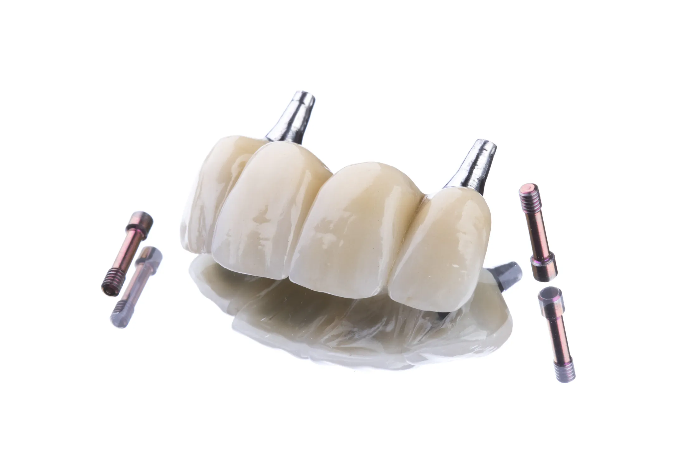 Dental Bridge