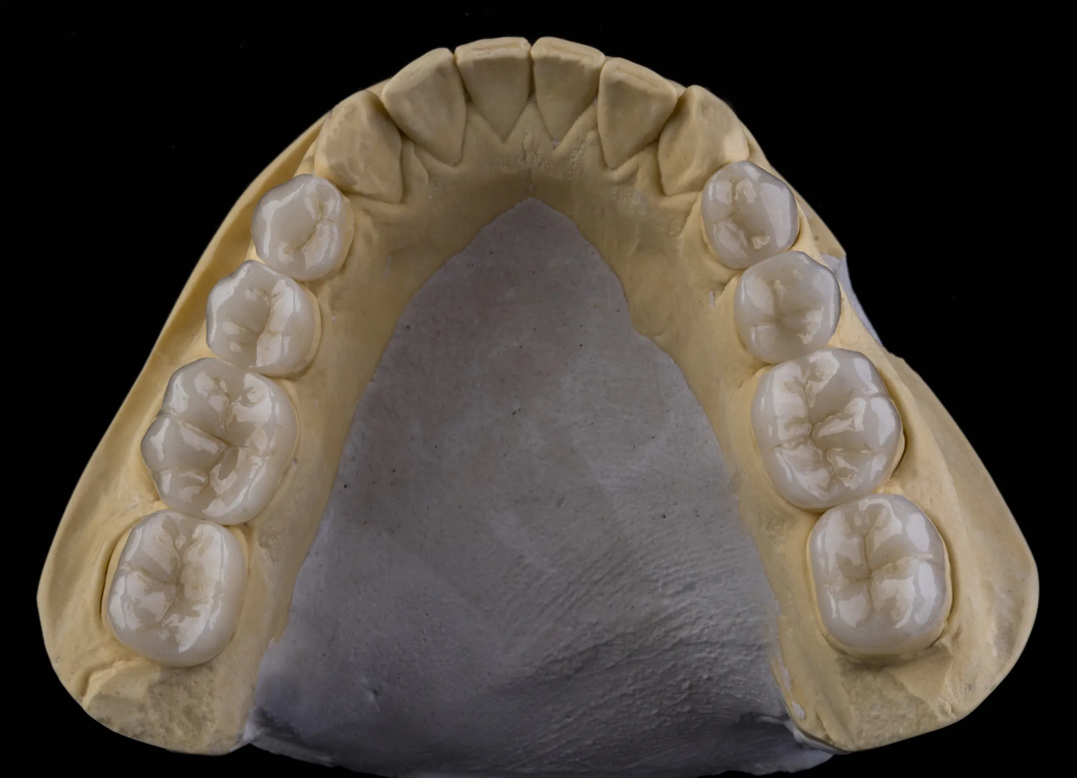 Dental Crown