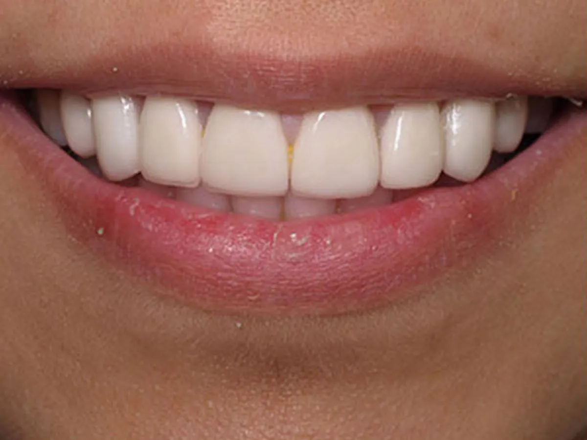 Smile Makeover Closeups Before & After Gallery - Patient 186105658 - Image 1