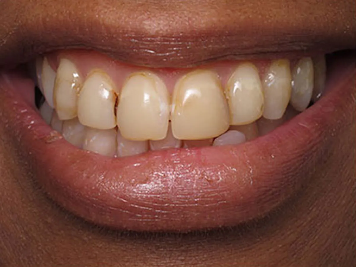 Smile Makeover Closeups Before & After Gallery - Patient 186105662 - Image 1