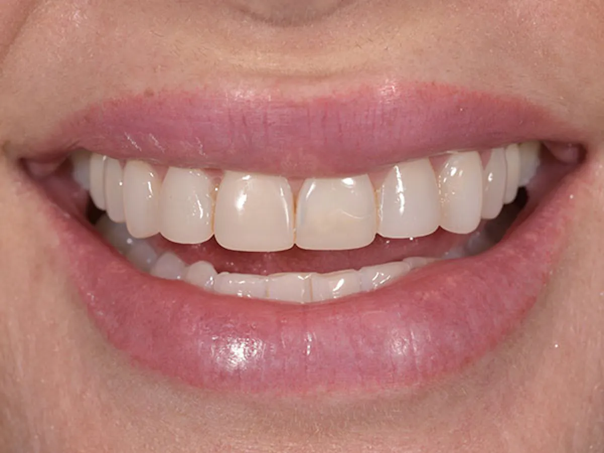 Smile Makeover Closeups Before & After Gallery - Patient 186106827 - Image 1