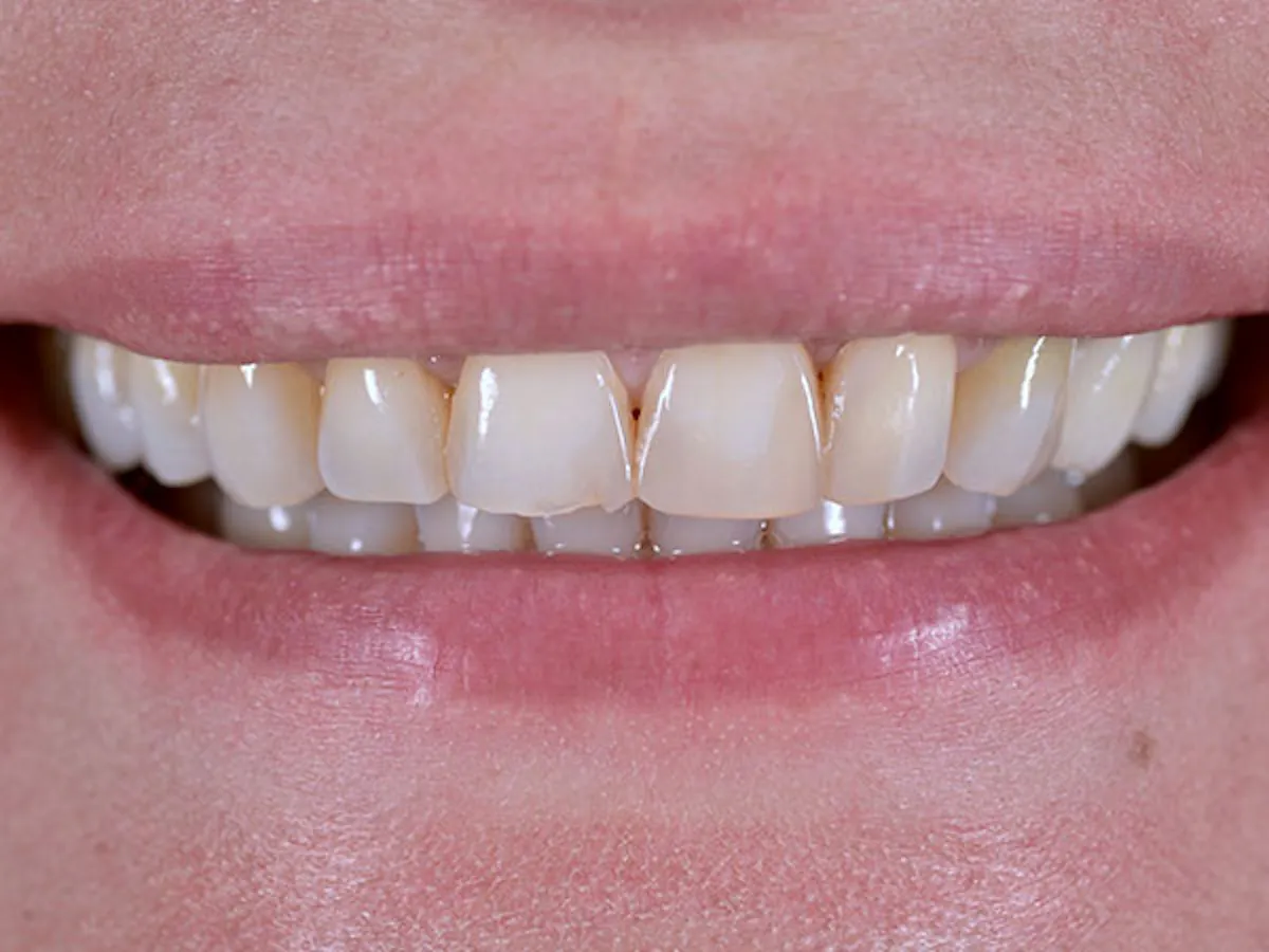Smile Makeover Closeups Before & After Gallery - Patient 186106847 - Image 1