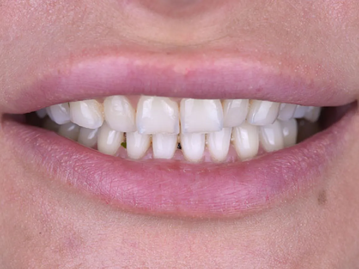 Smile Makeover Closeups Before & After Gallery - Patient 186113366 - Image 1