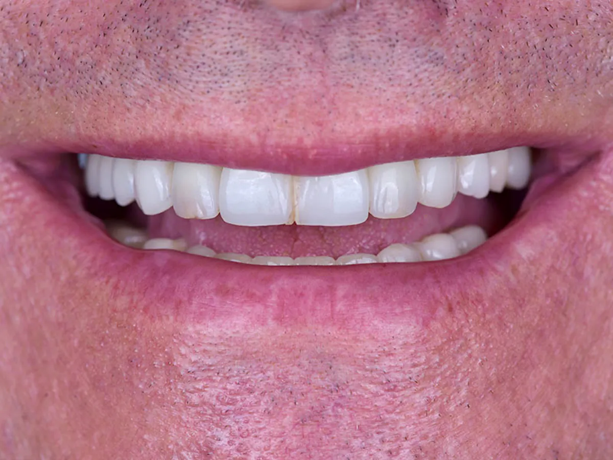 Smile Makeover Closeups Before & After Gallery - Patient 192281092 - Image 1