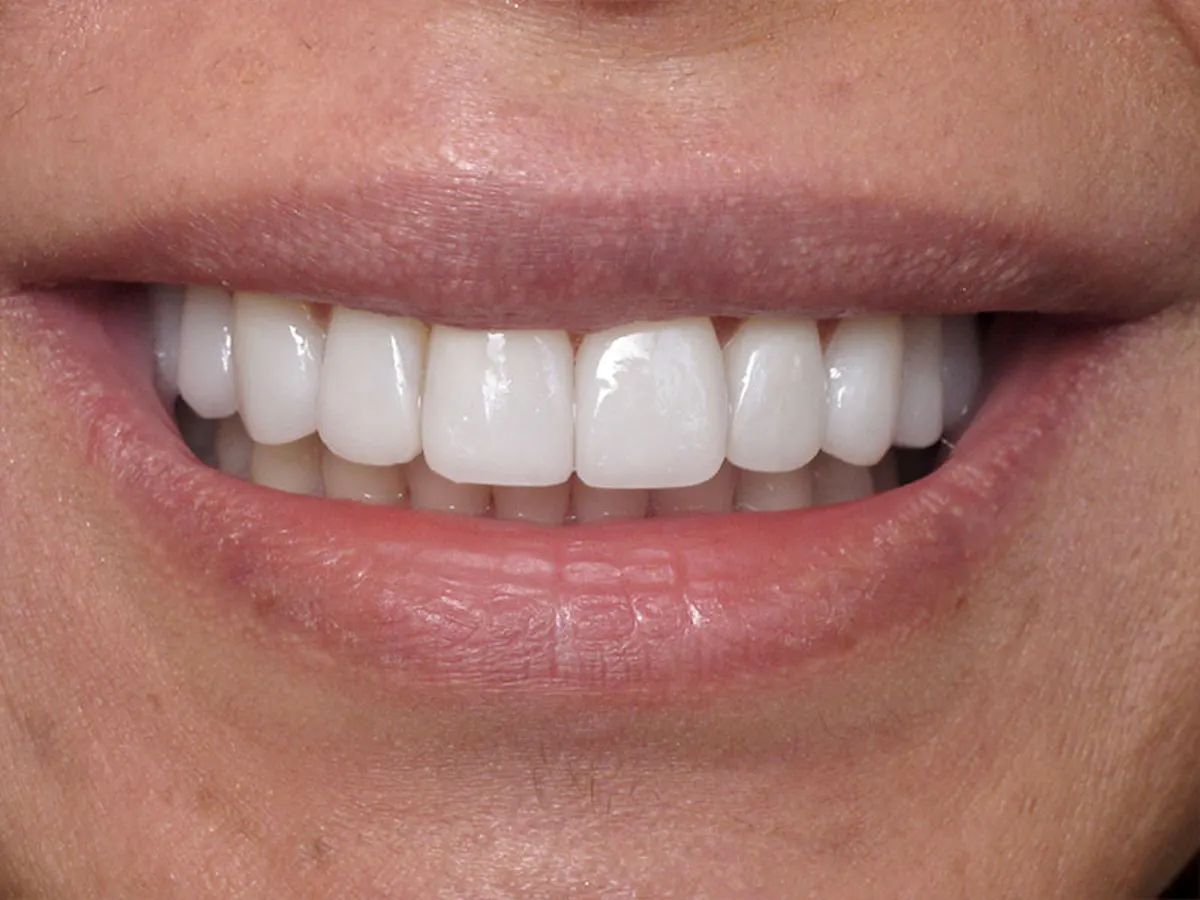 Smile Makeover Closeups Before & After Gallery - Patient 192463054 - Image 1