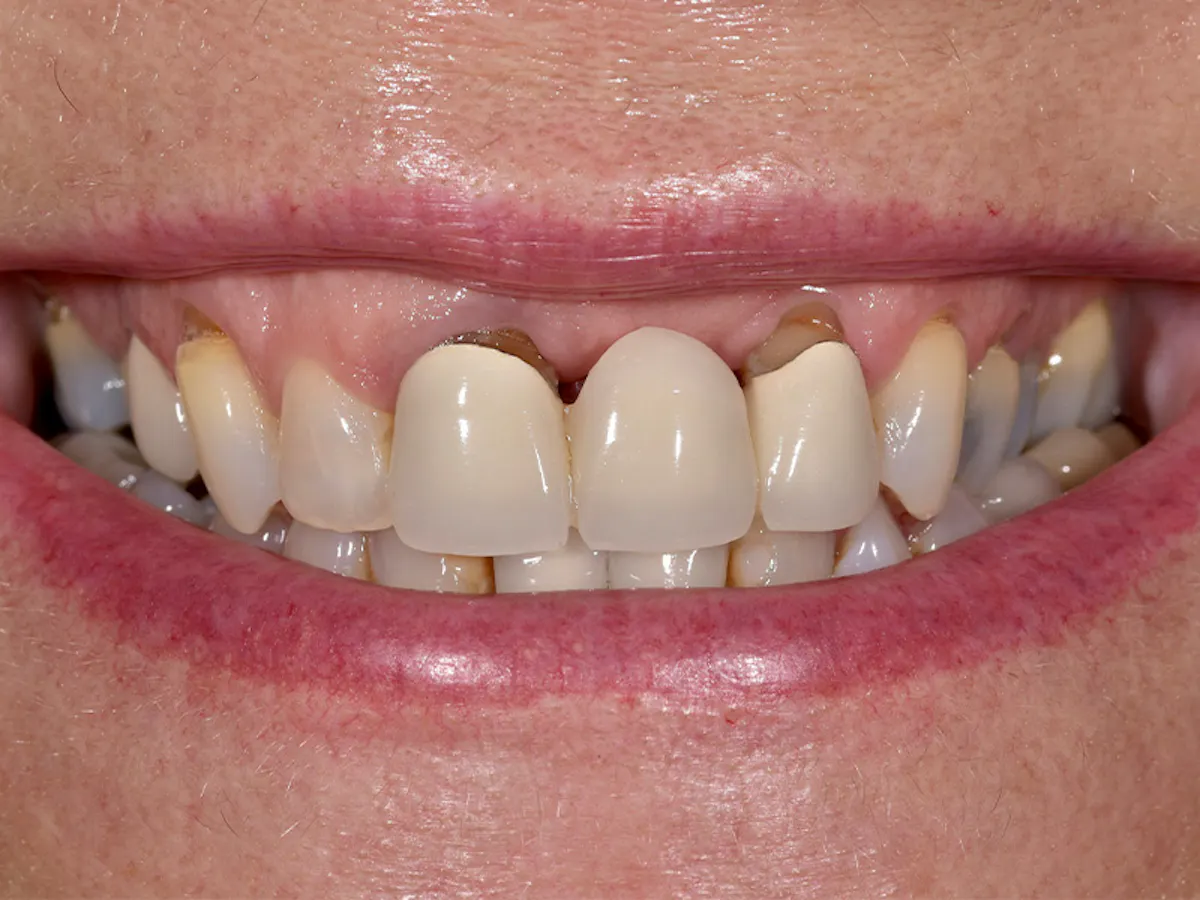 Smile Makeover Closeups Before & After Gallery - Patient 969787 - Image 1