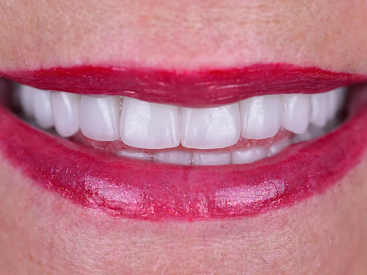 Smile Makeover Closeups Before & After Gallery - Patient 969787 - Image 2