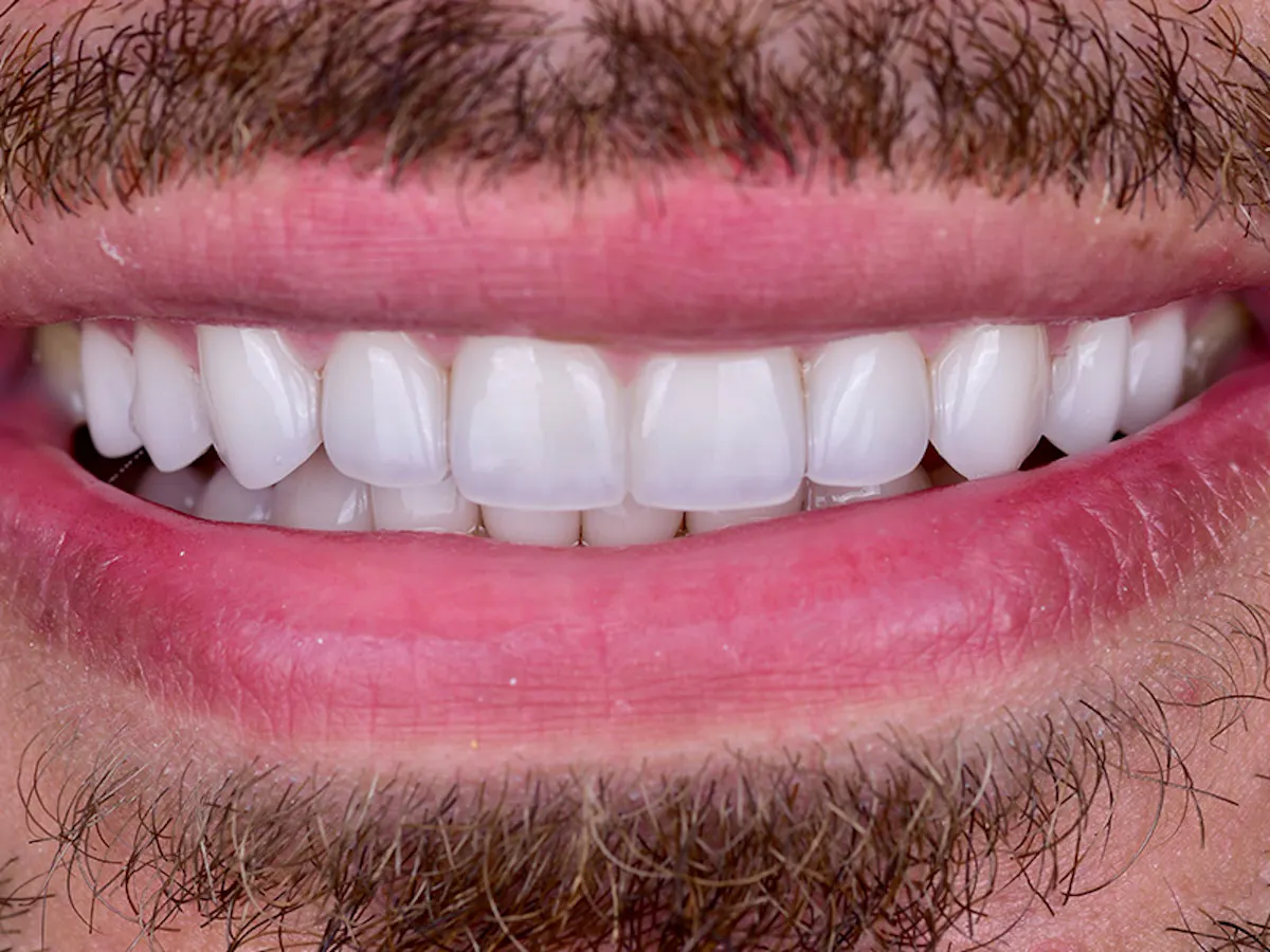 Smile Makeover Closeups Before & After Gallery - Patient 973947 - Image 2