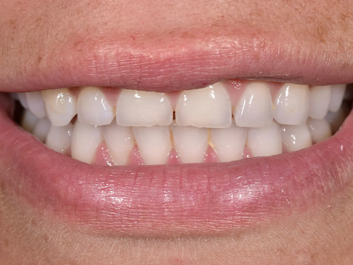 Smile Makeover Closeups Before & After Gallery - Patient 100593 - Image 1