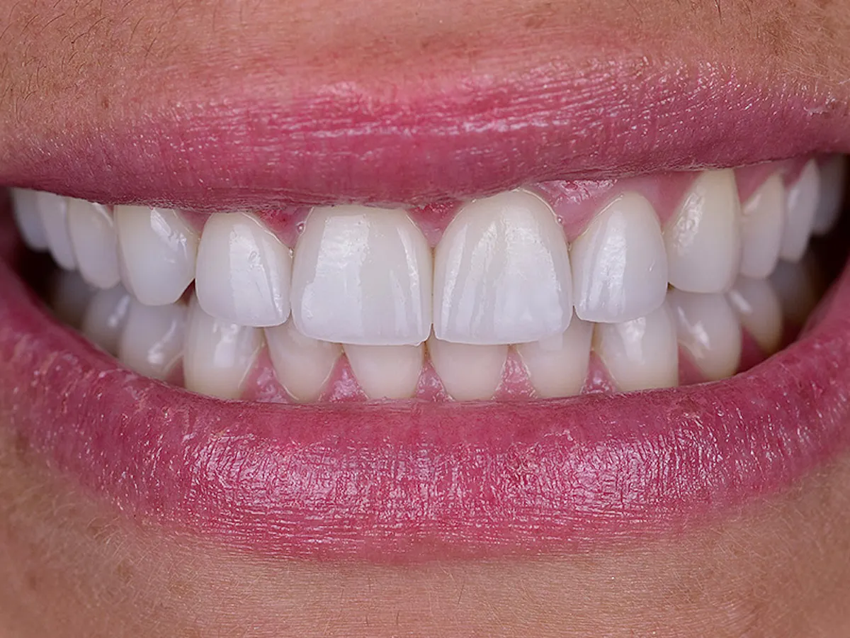 Smile Makeover Closeups Before & After Gallery - Patient 100593 - Image 2