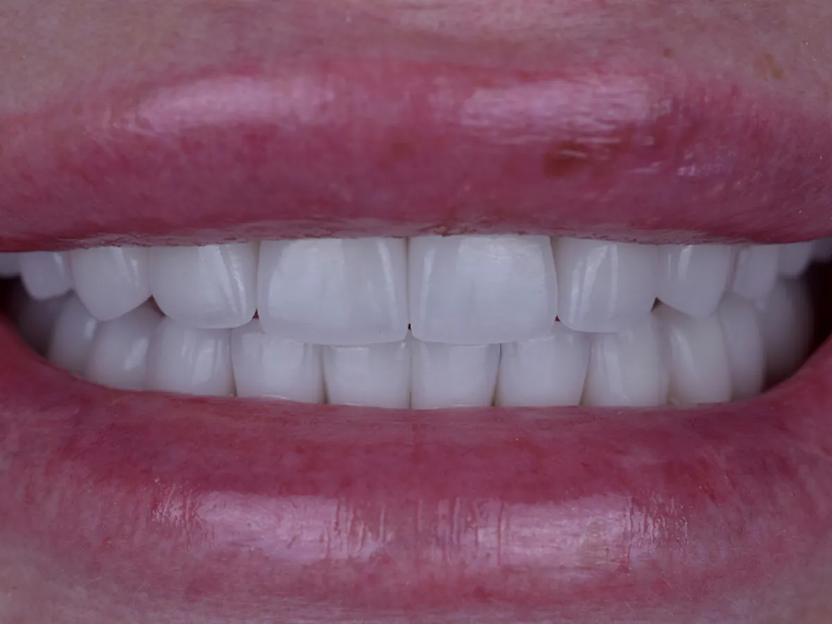 Smile Makeover Closeups Before & After Gallery - Patient 216343 - Image 2