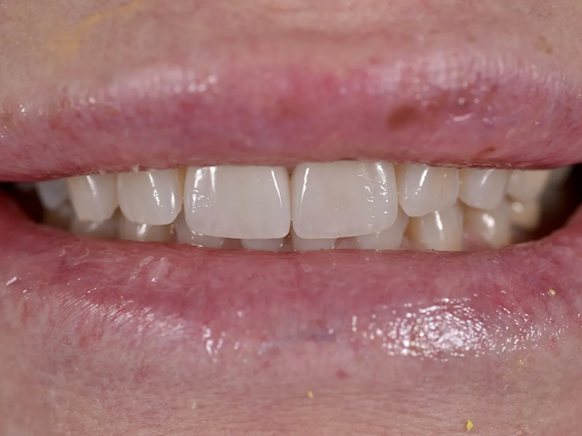 Smile Makeover Closeups Before & After Gallery - Patient 216343 - Image 1