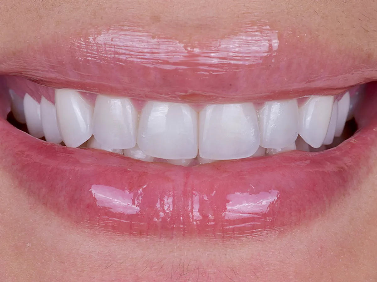 Smile Makeover Closeups Before & After Gallery - Patient 172040 - Image 2