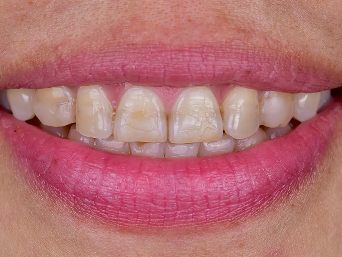 Smile Makeover Closeups Before & After Gallery - Patient 339370 - Image 1