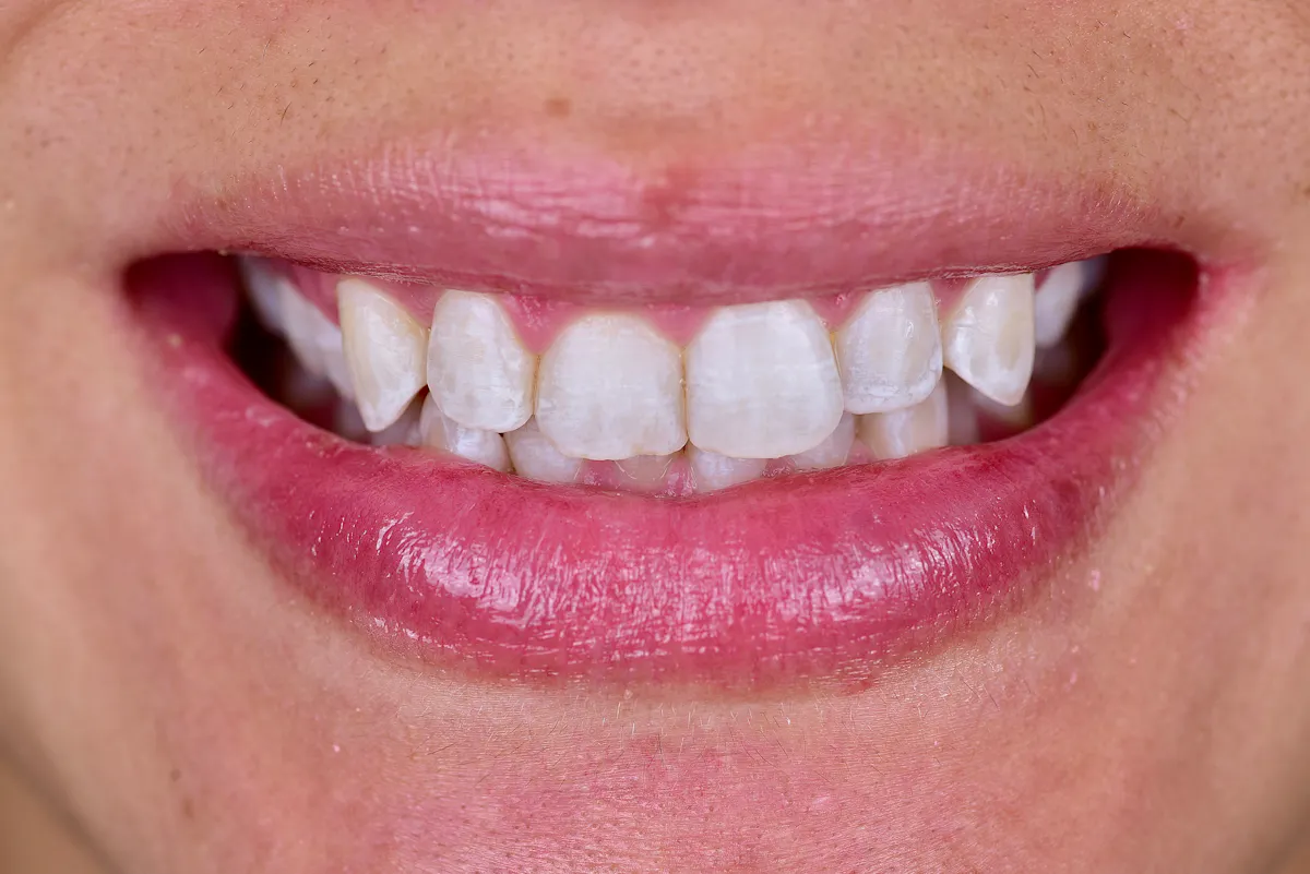 Smile Makeover Closeups Before & After Gallery - Patient 172040 - Image 1